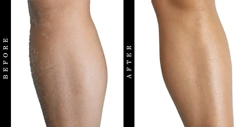 DRMTLGY Exfoliating Body Lotion Before and After